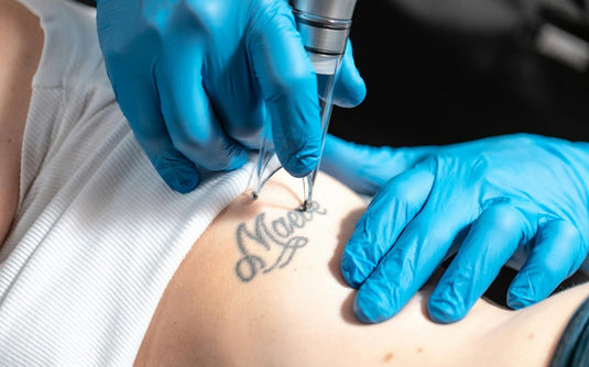 Tattoo Removal or Lightening
