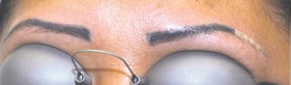 Tattoo Removal - Eyebrows