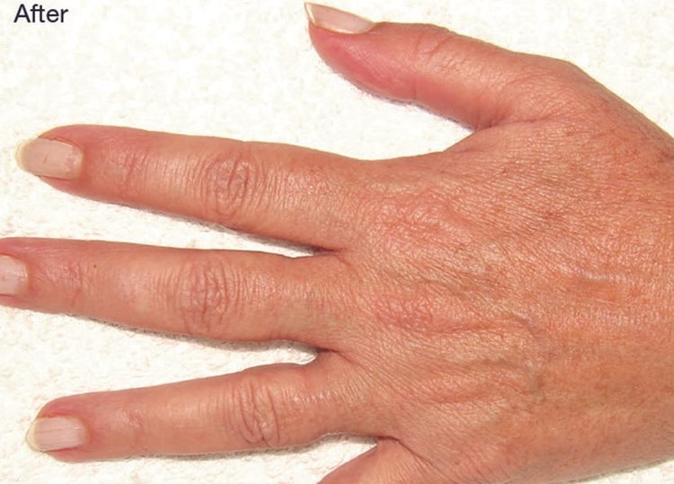 Skin Rejuvenation - Hand