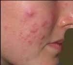 Skin Rejuvenation - Active Acne