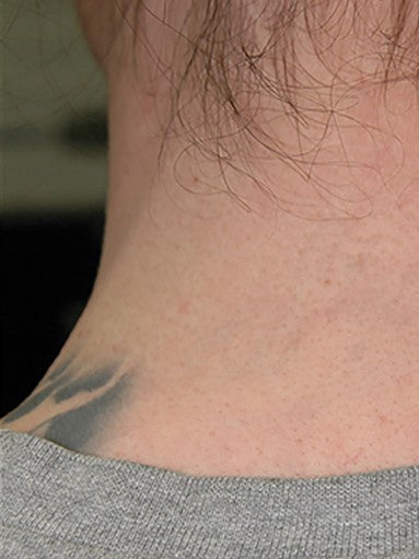 Tattoo Removal - Neck