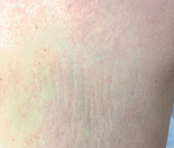 Skin Rejuvenation - Scars, Stretch Marks